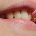 Ako ošetrovať ranu po vytrhnutom zube?
