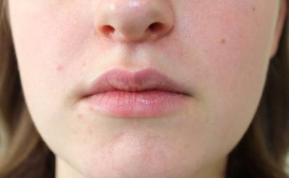 Periorálna dermatitída: ako sa zbaviť nevzhľadných vyrážok okolo úst? 