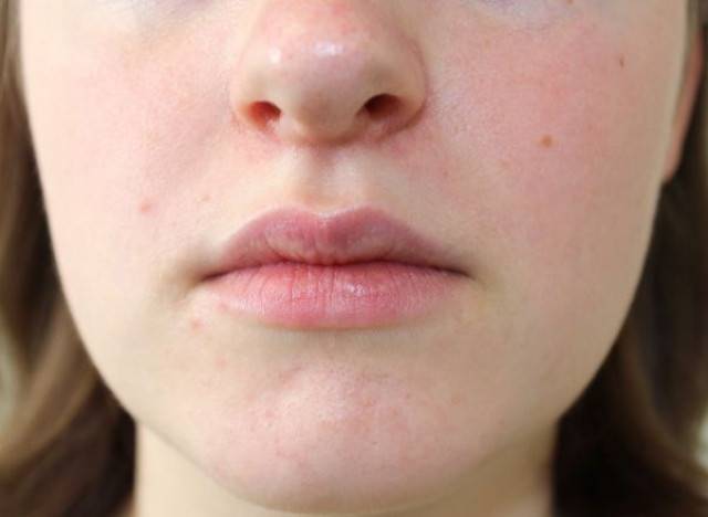 Periorálna dermatitída: ako sa zbaviť nevzhľadných vyrážok okolo úst? 