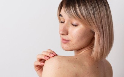 Zbavte sa jaziev po akné: Tipy od dermatológov a overené domáce recepty