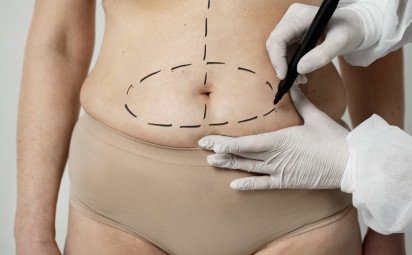 Zvažujete liposukciu? Všetko, čo by ste o nej mali vedieť