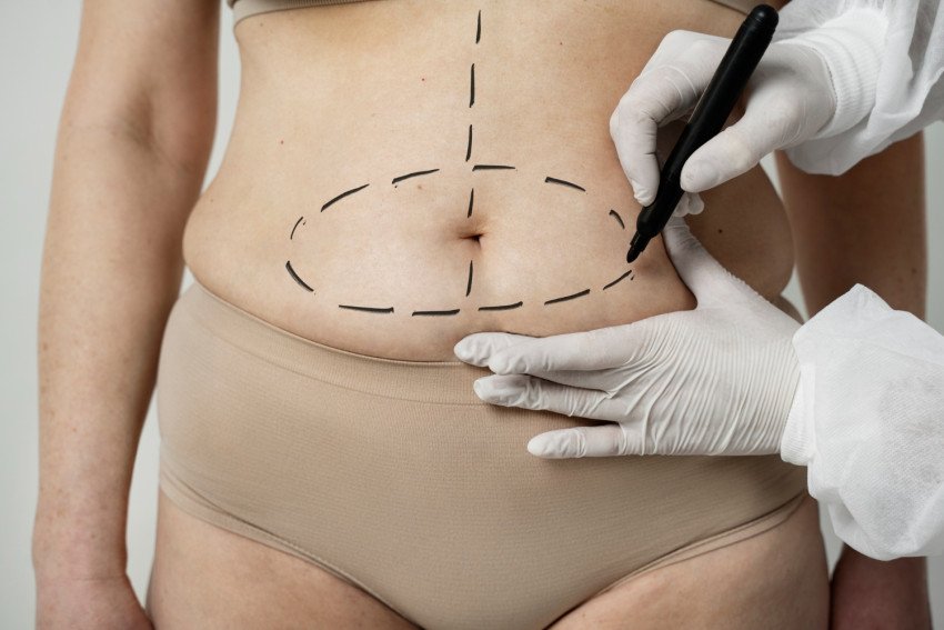 Zvažujete liposukciu? Všetko, čo by ste o nej mali vedieť Zvažujete liposukciu? Všetko, čo by ste o nej mali vedieť