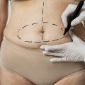 Zvažujete liposukciu? Všetko, čo by ste o nej mali vedieť