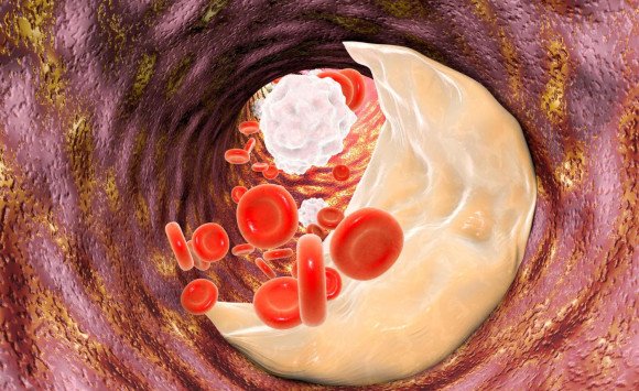 Neriskujte svoj komfort. Čo všetko môžu signalizovať zvýšené triglyceridy?