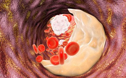 Neriskujte svoj komfort. Čo všetko môžu signalizovať zvýšené triglyceridy?